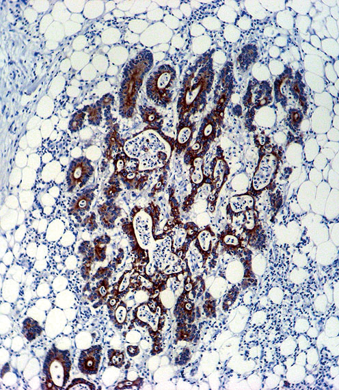 Paraformaldehyde-fixed, paraffin embedded human colon carcinoma tissue; Antigen retrieval by boiling in sodium citrate buffer (pH6.0) for 15min; Block endogenous peroxidase by 3% hydrogen peroxide for 15 minutes; Blocking buffer (3% BSA) at room temperature for 30min; Antibody incubation with TGFB2 (220ct16.4.3.1) Monoclonal Antibody (bsm-51058M) at 1:50 for 1 hour at 37°C, followed by a conjugated secondary antibody for 20 minutes and DAB staining.
