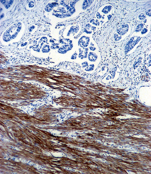 Paraformaldehyde-fixed, paraffin embedded human colon carcinoma tissue; Antigen retrieval by boiling in sodium citrate buffer (pH6.0) for 15min; Block endogenous peroxidase by 3% hydrogen peroxide for 15 minutes; Blocking buffer (3% BSA) at room temperature for 30min; Antibody incubation with ACTA1 (337CT30.10.1) Monoclonal Antibody (bsm-51104M) at 1:50 for 1 hour at 37°C, followed by a conjugated secondary antibody for 20 minutes and DAB staining.