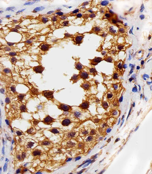 Paraformaldehyde-fixed, paraffin embedded Human Testis tissue; Antigen retrieval by boiling in sodium citrate buffer (pH6.0) for 15min; Block endogenous peroxidase by 3% hydrogen peroxide for 15 minutes; Blocking buffer (3% BSA) at room temperature for 30min; Antibody incubation with VEGFR3 (818CT12.1.1) Monoclonal Antibody (bsm-51245M) at 1:25 for 1 hour at 37°C, followed by a conjugated secondary antibody for 20 minutes and DAB staining.