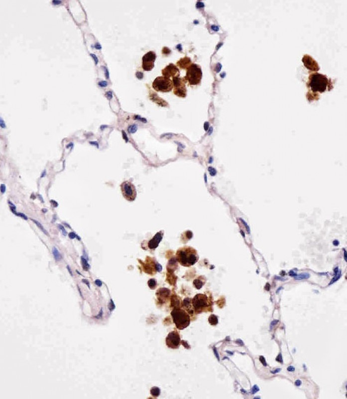 Paraformaldehyde-fixed, paraffin embedded Human lungtissue; Antigen retrieval by boiling in sodium citrate buffer (pH6.0) for 15min; Block endogenous peroxidase by 3% hydrogen peroxide for 15 minutes; Blocking buffer (3% BSA) at room temperature for 30min; Antibody incubation with ANTIBODY Monoclonal Antibody (bsm-51247M) at 1:25 for 1 hour at 37°C, followed by a conjugated secondary antibody for 20 minutes and DAB staining.