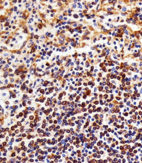 Paraformaldehyde-fixed, paraffin embedded Human Spleen tissue; Antigen retrieval by boiling in sodium citrate buffer (pH6.0) for 15min; Block endogenous peroxidase by 3% hydrogen peroxide for 15 minutes; Blocking buffer (3% BSA) at room temperature for 30min; Antibody incubation with NFKB1 (8C3) Monoclonal Antibody (bsm-51258M) at 1:25 for 1 hour at 37°C, followed by a conjugated secondary antibody for 20 minutes and DAB staining.