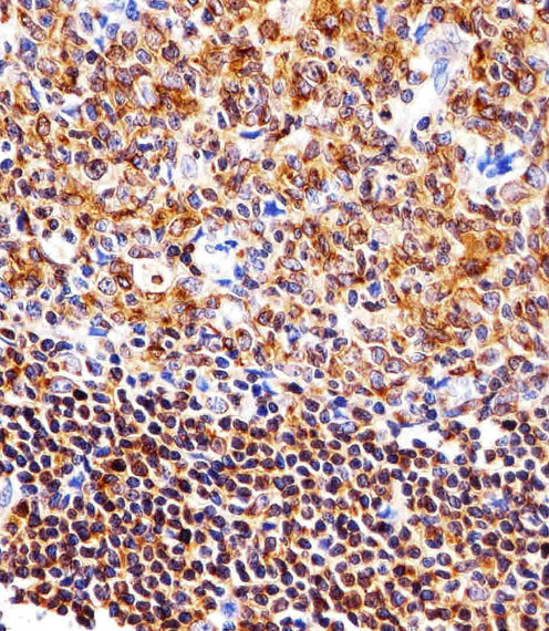 Paraformaldehyde-fixed, paraffin embedded Human tonsil tissue; Antigen retrieval by boiling in sodium citrate buffer (pH6.0) for 15min; Block endogenous peroxidase by 3% hydrogen peroxide for 15 minutes; Blocking buffer (3% BSA) at room temperature for 30min; Antibody incubation with NFKB1 (8C3) Monoclonal Antibody (bsm-51258M) at 1:25 for 1 hour at 37°C, followed by a conjugated secondary antibody for 20 minutes and DAB staining.
