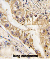 Paraformaldehyde-fixed, paraffin embedded human lung carcinoma tissue; Antigen retrieval by boiling in sodium citrate buffer (pH6.0) for 15min; Block endogenous peroxidase by 3% hydrogen peroxide for 15 minutes; Blocking buffer (3% BSA) at room temperature for 30min; Antibody incubation with EPHB2 (48CT12.6.4) Monoclonal Antibody (bsm-51269M) at 1:200 for 1 hour at 37°C, followed by a conjugated secondary antibody for 20 minutes and DAB staining.