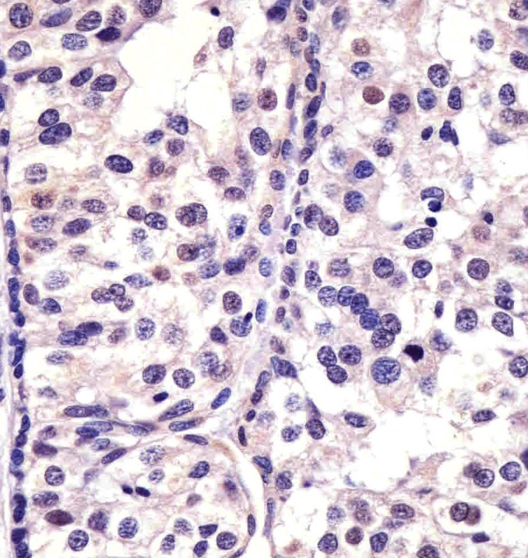 Paraformaldehyde-fixed, paraffin embedded human breast carcinoma; Antigen retrieval by boiling in sodium citrate buffer (pH6.0) for 15min; Block endogenous peroxidase by 3% hydrogen peroxide for 15 minutes; Blocking buffer (3% BSA) at room temperature for 30min; Antibody incubation with CDK4 (9C3) Monoclonal Antibody (bsm-51314M) at 1:25 for 1 hour at 37°C, followed by a conjugated secondary antibody for 20 minutes and DAB staining