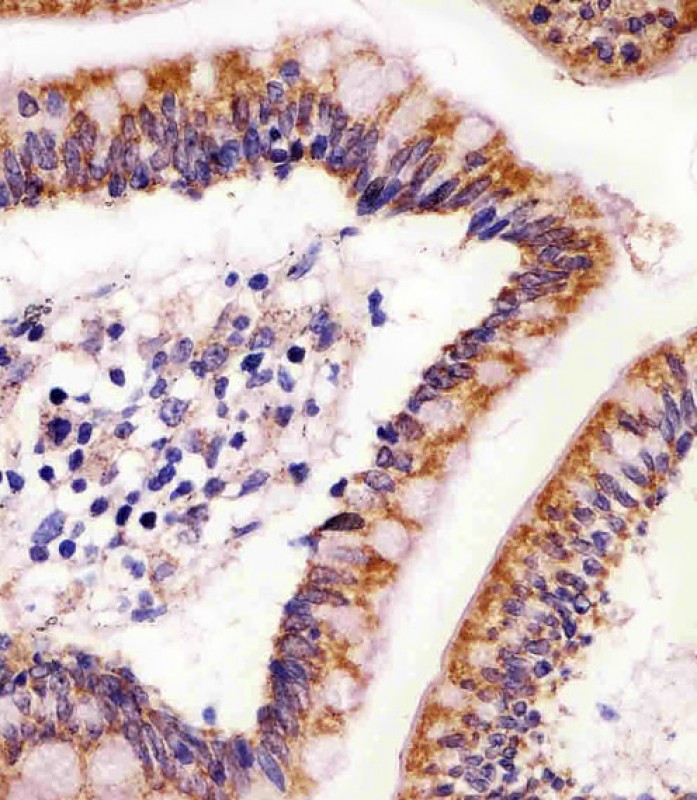 Paraformaldehyde-fixed, paraffin embedded human colon tissue; Antigen retrieval by boiling in sodium citrate buffer (pH6.0) for 15min; Block endogenous peroxidase by 3% hydrogen peroxide for 15 minutes; Blocking buffer (3% BSA) at room temperature for 30min; Antibody incubation with ABL2 (2C3) Monoclonal Antibody (bsm-51296M) at 1:25 for 1 hour at 37°C, followed by a conjugated secondary antibody for 20 minutes and DAB staining.