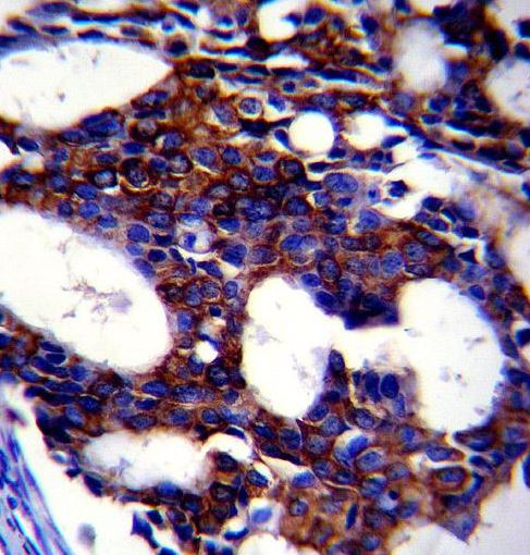 Paraformaldehyde-fixed, paraffin embedded human breast carcinoma; Antigen retrieval by boiling in sodium citrate buffer (pH6.0) for 15min; Block endogenous peroxidase by 3% hydrogen peroxide for 15 minutes; Blocking buffer (3% BSA) at room temperature for 30min; Antibody incubation with TGFB2 (220ct16.4.3.1) Monoclonal Antibody (bsm-51058M) at 1:50 for 1 hour at 37°C, followed by a conjugated secondary antibody for 20 minutes and DAB staining.