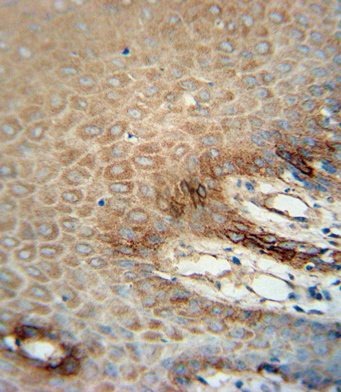 Paraformaldehyde-fixed, paraffin embedded human skin carcinoma; Antigen retrieval by boiling in sodium citrate buffer (pH6.0) for 15min; Block endogenous peroxidase by 3% hydrogen peroxide for 15 minutes; Blocking buffer (3% BSA) at room temperature for 30min; Antibody incubation with ITA6 (129CT49.6.5) Monoclonal Antibody (bsm-51027M) at 1:25 for 1 hour at 37°C, followed by a conjugated secondary antibody for 20 minutes and DAB staining.