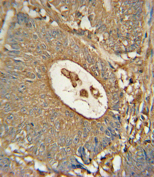 Paraformaldehyde-fixed, paraffin embedded human colon tissue; Antigen retrieval by boiling in sodium citrate buffer (pH6.0) for 15min; Block endogenous peroxidase by 3% hydrogen peroxide for 15 minutes; Blocking buffer (3% BSA) at room temperature for 30min; Antibody incubation with ACOX1 (153CT43.1.1) Monoclonal Antibody (bsm-51033M) at 1:25 for 1 hour at 37°C, followed by a conjugated secondary antibody for 20 minutes and DAB staining.