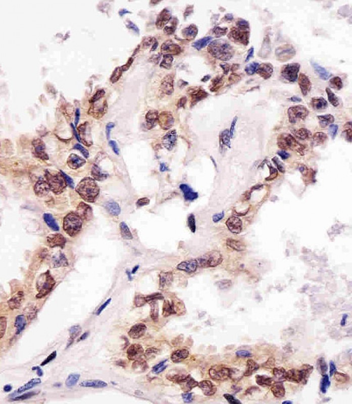 Paraformaldehyde-fixed, paraffin embedded human lung adenocarcinoma; Antigen retrieval by boiling in sodium citrate buffer (pH6.0) for 15min; Block endogenous peroxidase by 3% hydrogen peroxide for 15 minutes; Blocking buffer (3% BSA) at room temperature for 30min; Antibody incubation with SUMO1 (66AT1273.94) Monoclonal Antibody (bsm-51020M) at 1:25 for 1 hour at 37°C, followed by a conjugated secondary antibody for 20 minutes and DAB staining.