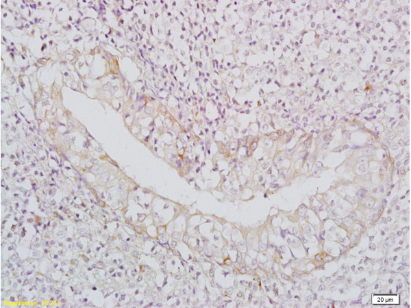 Formalin-fixed and paraffin-embedded: Human nasopharyngeal carcinoma labeled with Rabbit Anti-BAFF/CD257 Polyclonal Antibody, Unconjugated (bs-2431R) 1:400 followed by conjugation to the secondary antibody and DAB staining