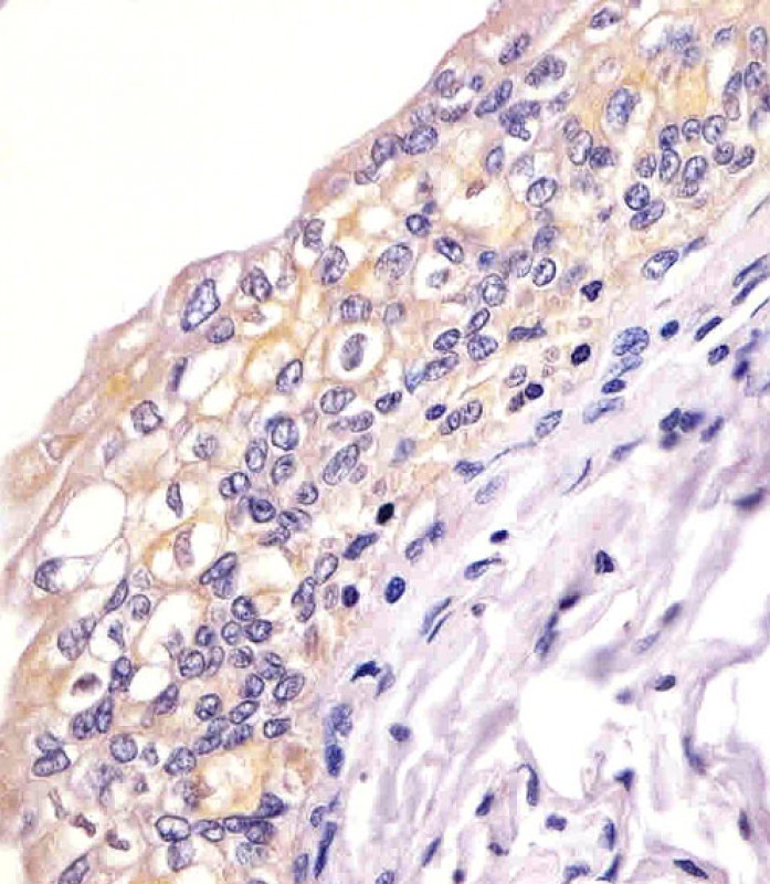 Paraformaldehyde-fixed, paraffin embedded human bladder tissue; Antigen retrieval by boiling in sodium citrate buffer (pH6.0) for 15min; Block endogenous peroxidase by 3% hydrogen peroxide for 15 minutes; Blocking buffer (3% BSA) at room temperature for 30min; Antibody incubation with BID (9C7) Monoclonal Antibody (bsm-51306M) at 1:25 for 1 hour at 37°C, followed by a conjugated secondary antibody for 20 minutes and DAB staining.