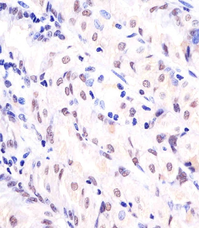 Paraformaldehyde-fixed, paraffin embedded human stomach tissue; Antigen retrieval by boiling in sodium citrate buffer (pH6.0) for 15min; Block endogenous peroxidase by 3% hydrogen peroxide for 15 minutes; Blocking buffer (3% BSA) at room temperature for 30min; Antibody incubation with APEX1 (15C2) Monoclonal Antibody (bsm-51448M) at 1:25 for 1 hour at 37°C, followed by a conjugated secondary antibody for 20 minutes and DAB staining.