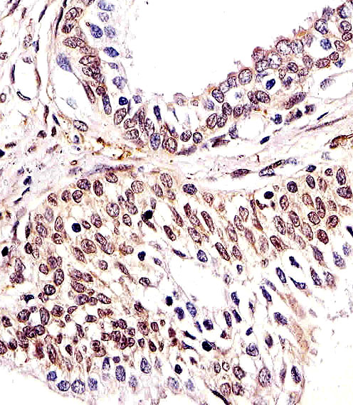 Paraformaldehyde-fixed, paraffin embedded human prostate tissue; Antigen retrieval by boiling in sodium citrate buffer (pH6.0) for 15min; Block endogenous peroxidase by 3% hydrogen peroxide for 15 minutes; Blocking buffer (3% BSA) at room temperature for 30min; Antibody incubation with H2AFX (8C5) Monoclonal Antibody (bsm-51222M) at 1:25 for 1 hour at 37°C, followed by a conjugated secondary antibody for 20 minutes and DAB staining.