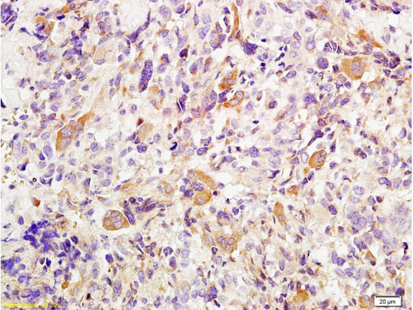 Formalin-fixed and paraffin embedded human osteosarcoma tissue labeled with Anti-Twist Polyclonal Antibody (bs-2441R), Unconjugated at 1:200 followed by conjugation to the secondary antibody, (SP-0023), and DAB staining