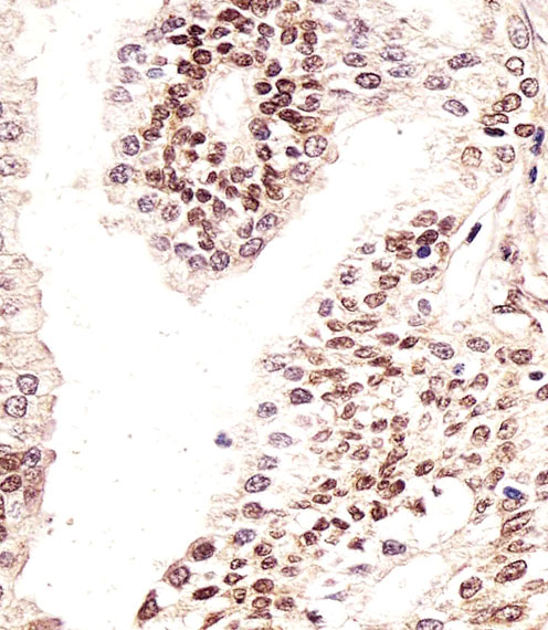 Paraformaldehyde-fixed, paraffin embedded human prostate tissue; Antigen retrieval by boiling in sodium citrate buffer (pH6.0) for 15min; Block endogenous peroxidase by 3% hydrogen peroxide for 15 minutes; Blocking buffer (3% BSA) at room temperature for 30min; Antibody incubation with H2AFX (9D5) Monoclonal Antibody (bsm-51225M) at 1:25 for 1 hour at 37°C, followed by a conjugated secondary antibody for 20 minutes and DAB staining.