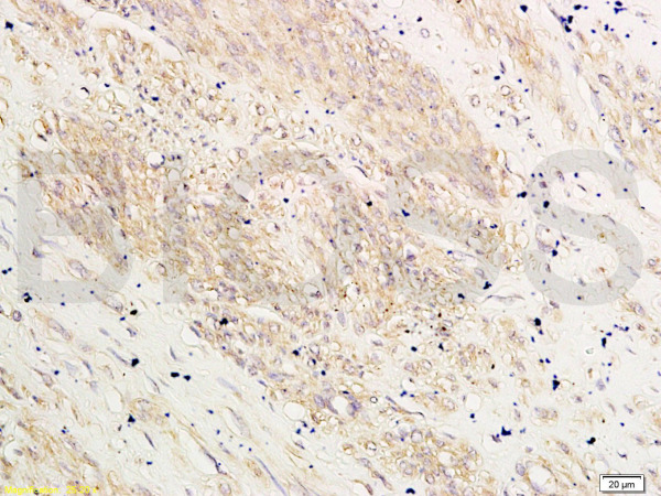 Formalin-fixed and paraffin-embedded: human breast cancer labeled with Rabbit Anti-HOXA10 Polyclonal Antibody (bs-2502R), Unconjugated 1:200 followed by conjugation to the secondary antibody and DAB staining