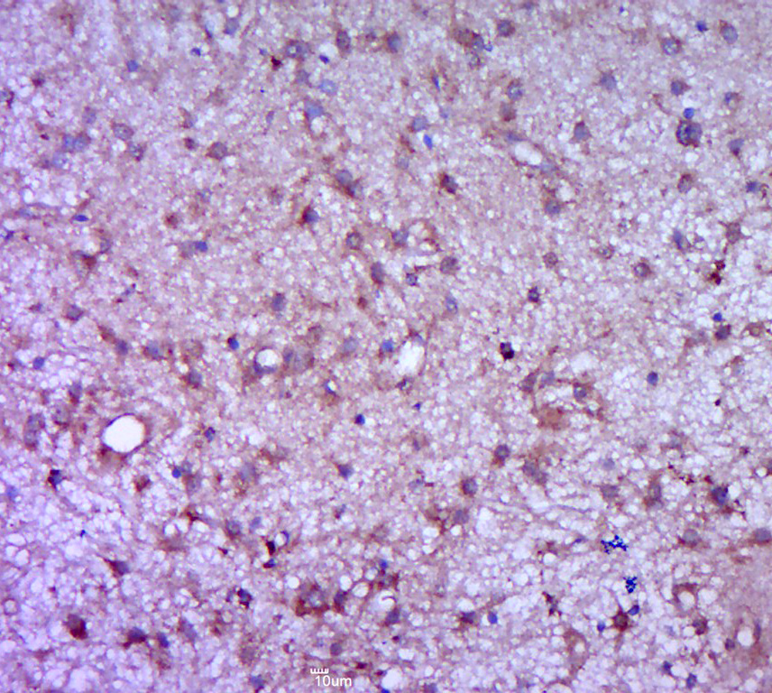 Paraformaldehyde-fixed, paraffin embedded human brain glioma; Antigen retrieval by boiling in sodium citrate buffer (pH6.0) for 15min; Block endogenous peroxidase by 3% hydrogen peroxide for 20 minutes; Blocking buffer (normal goat serum) at 37°C for 30min; Antibody incubation with CSF3 Polyclonal Antibody, Unconjugated (bs-1023R) at 1:400 overnight at 4°C, followed by a conjugated secondary for 20 minutes and DAB staining.