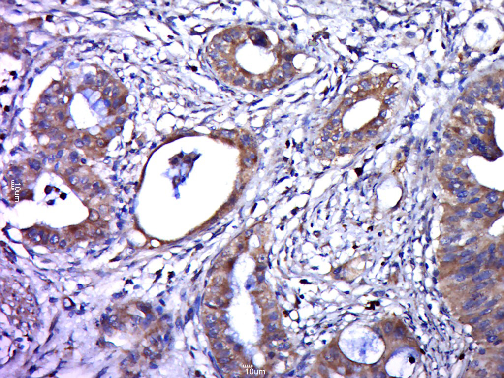 Paraformaldehyde-fixed, paraffin embedded human cervical cancer; Antigen retrieval by boiling in sodium citrate buffer (pH6.0) for 15min; Block endogenous peroxidase by 3% hydrogen peroxide for 20 minutes; Blocking buffer (normal goat serum) at 37°C for 30min; Antibody incubation with HPV16 E6 protein Polyclonal Antibody, Unconjugated (bs-0990R) at 1:400 overnight at 4°C, followed by a conjugated secondary for 20 minutes and DAB staining.