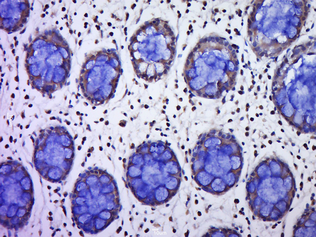 Paraformaldehyde-fixed, paraffin embedded human colon cancer; Antigen retrieval by boiling in sodium citrate buffer (pH6.0) for 15min; Block endogenous peroxidase by 3% hydrogen peroxide for 20 minutes; Blocking buffer (normal goat serum) at 37°C for 30min; Antibody incubation with C9orf96 Polyclonal Antibody, Unconjugated (bs-15350R) at 1:400 overnight at 4°C, followed by a conjugated secondary for 20 minutes and DAB staining.