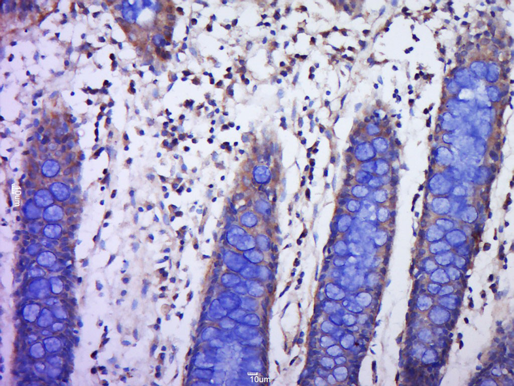 Paraformaldehyde-fixed, paraffin embedded human colon cancer; Antigen retrieval by boiling in sodium citrate buffer (pH6.0) for 15min; Block endogenous peroxidase by 3% hydrogen peroxide for 20 minutes; Blocking buffer (normal goat serum) at 37°C for 30min; Antibody incubation with PLGF Polyclonal Antibody, Unconjugated (bs-0281R) at 1:400 overnight at 4°C, followed by a conjugated secondary for 20 minutes and DAB staining.