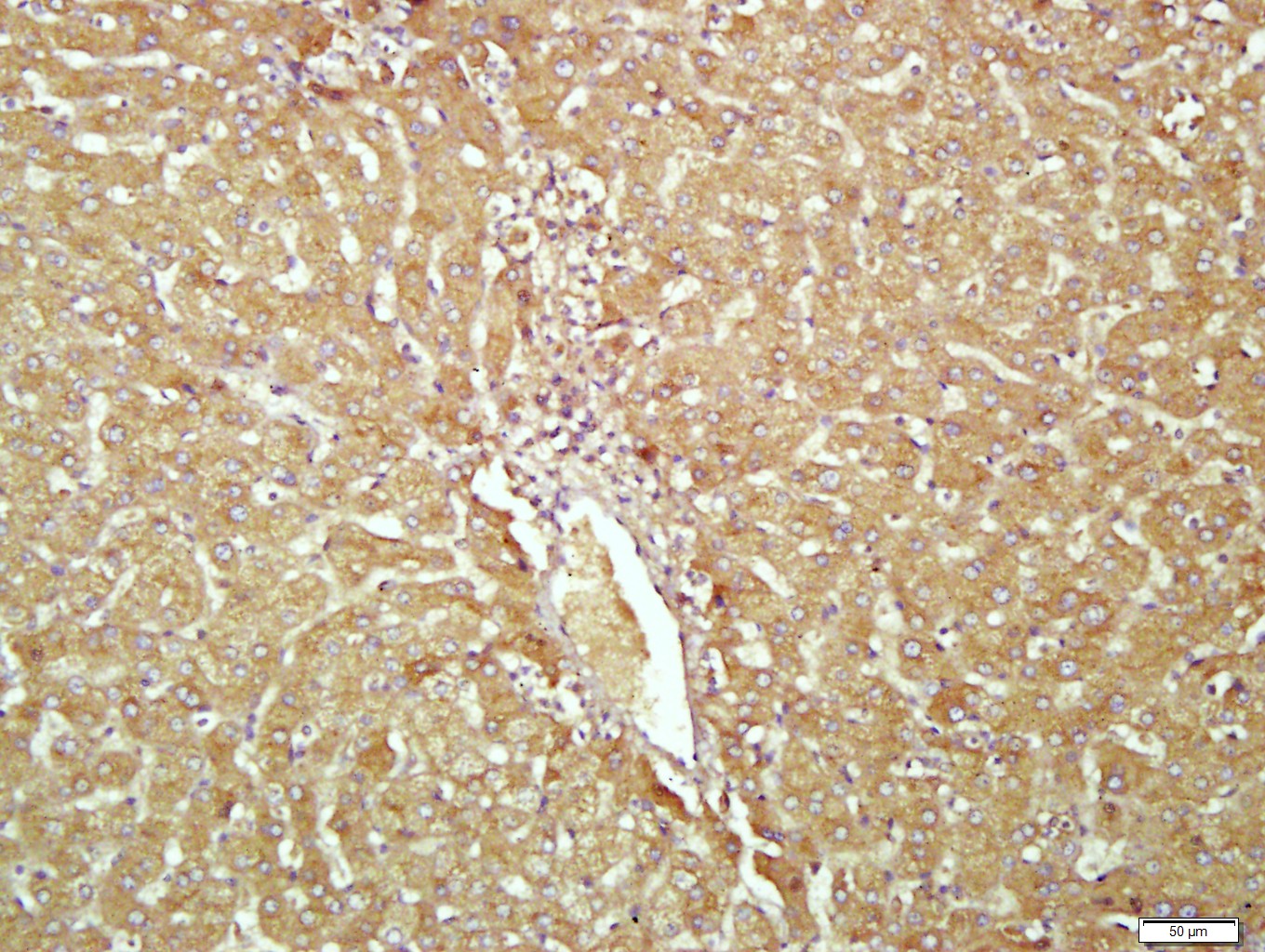 Paraformaldehyde-fixed, paraffin embedded human liver cancer; Antigen retrieval by boiling in sodium citrate buffer (pH6.0) for 15min; Block endogenous peroxidase by 3% hydrogen peroxide for 20 minutes; Blocking buffer (normal goat serum) at 37°C for 30min; Antibody incubation with Transferrin(1F10) Monoclonal Antibody, Unconjugated (bsm-2052M) at 1:400 overnight at 4°C, followed by a conjugated secondary antibody for 20 minutes and DAB staining.