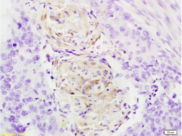 Formalin-fixed and paraffin embedded human esophageal carcinoma tissue labeled with Anti-Cathepsin B Polyclonal Antibody, Unconjugated(bs-1500R) at 1:200 followed by conjugation to the secondary antibody, (SP-0023), and DAB staining