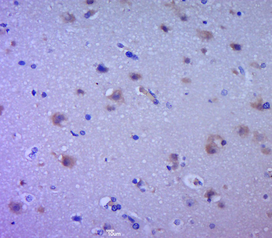 Paraformaldehyde-fixed, paraffin embedded human brain glioma; Antigen retrieval by boiling in sodium citrate buffer (pH6.0) for 15min; Block endogenous peroxidase by 3% hydrogen peroxide for 20 minutes; Blocking buffer (normal goat serum) at 37°C for 30min; Antibody incubation with EGFR Polyclonal Antibody, Unconjugated (bs-0165R) at 1:400 overnight at 4°C, followed by a conjugated secondary for 20 minutes and DAB staining.