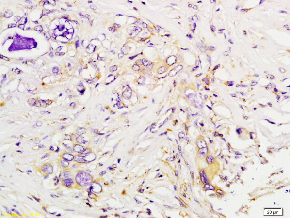 Formalin-fixed and paraffin embedded human colon carcinoma tissue labeled with Anti-Tsg101 Polyclonal Antibody (bs-1365R), Unconjugated at 1:200 followed by conjugation to the secondary antibody, (SP-0023), and DAB staining