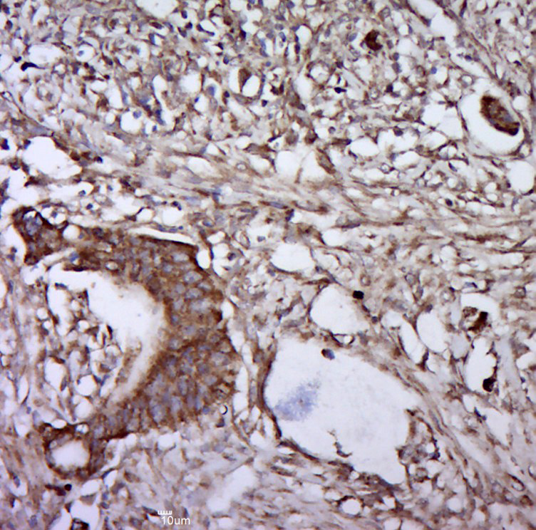 Paraformaldehyde-fixed, paraffin embedded human cervical cancer; Antigen retrieval by boiling in sodium citrate buffer (pH6.0) for 15min; Block endogenous peroxidase by 3% hydrogen peroxide for 20 minutes; Blocking buffer (normal goat serum) at 37°C for 30min; Antibody incubation with phospho-gp130 (Ser782) Polyclonal Antibody, Unconjugated (bs-10122R) at 1:400 overnight at 4°C, followed by a conjugated secondary for 20 minutes and DAB staining._x000D_ _x000D_