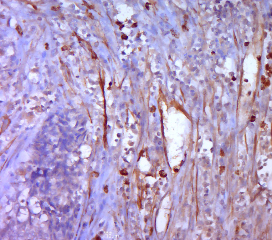 Paraformaldehyde-fixed, paraffin embedded human cervical cancer; Antigen retrieval by boiling in sodium citrate buffer (pH6.0) for 15min; Block endogenous peroxidase by 3% hydrogen peroxide for 20 minutes; Blocking buffer (normal goat serum) at 37°C for 30min; Antibody incubation with Mesothelin Polyclonal Antibody, Unconjugated (bs-0300R) at 1:400 overnight at 4°C, followed by a conjugated secondary for 20 minutes and DAB staining.