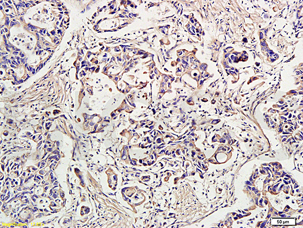 Formalin-fixed and paraffin-embedded human gastric carcinoma labeled with Rabbit Anti-IDE Polyclonal Antibody, Unconjugated (bs-0018R) at 1:300 followed by conjugation to the secondary antibody and DAB staining