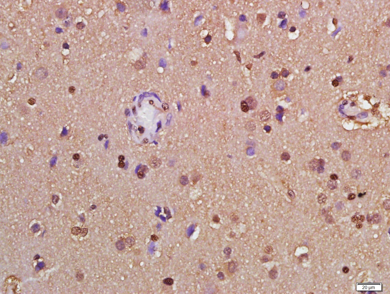Paraformaldehyde-fixed, paraffin embedded human glioma; Antigen retrieval by boiling in sodium citrate buffer (pH6.0) for 15min; Block endogenous peroxidase by 3% hydrogen peroxide for 20 minutes; Blocking buffer (normal goat serum) at 37°C for 30min; Antibody incubation with GAPDH Polyclonal Antibody, Unconjugated (bs-10900R) at 1:500 overnight at 4°C, followed by a conjugated secondary for 20 minutes and DAB staining.