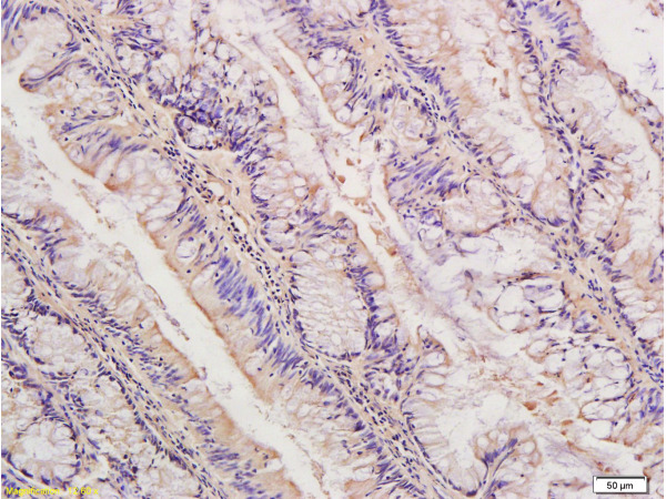 Formalin-fixed and paraffin embedded human colon cancer labeled with Anti-IDE Polyclonal Antibody, Unconjugated (bs-0018R) at 1:300, followed by conjugation to the secondary antibody and DAB staining