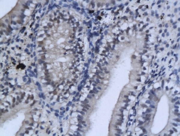Formalin-fixed and paraffin embedded human endometrium carcinoma labeled with Rabbit Anti-GSK-3 Beta (CT) Polyclonal Antibody, Unconjugated  (bs-0028R) 1:200 followed by conjugation to the secondary antibody and DAB staining