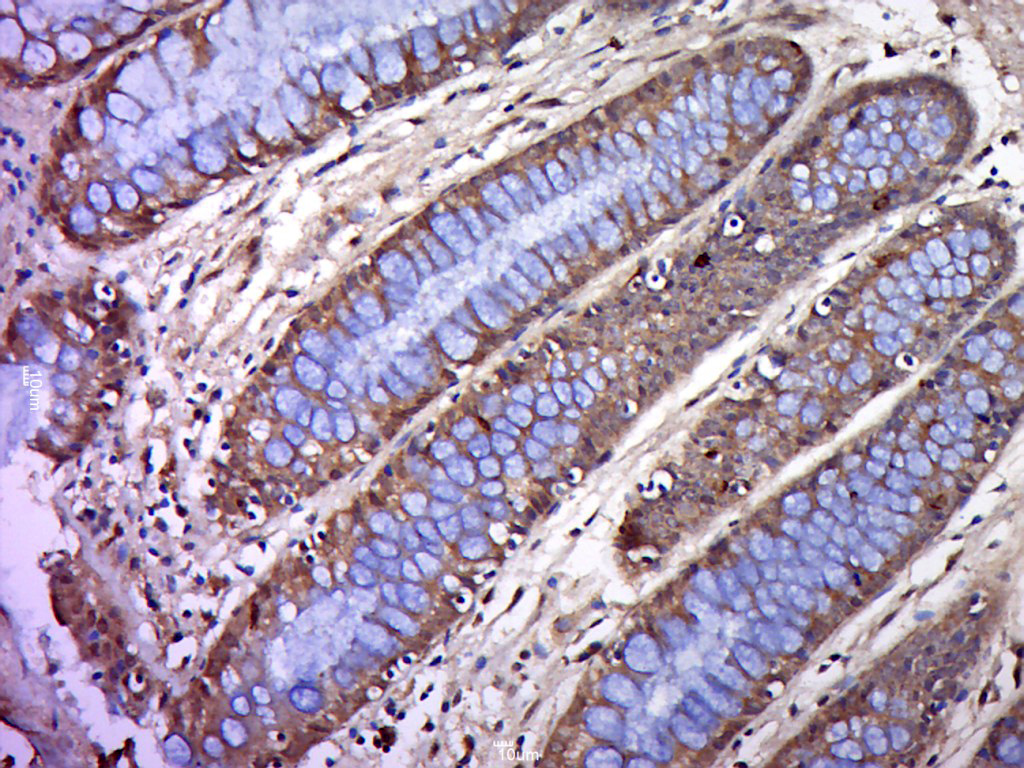 Formalin-fixed and paraffin embedded human colon cancer labeled with BTN2A1 Polyclonal Antibody, Unconjugated (bs-20473R) at 1:200, followed by conjugation to the secondary antibody and DAB staining