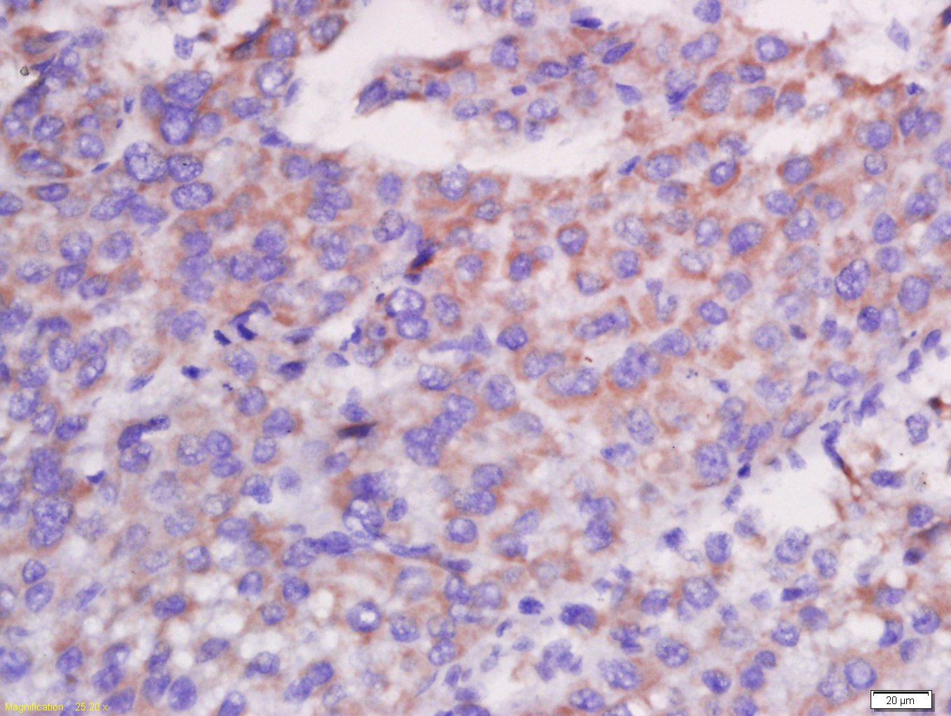 Paraformaldehyde-fixed, paraffin embedded human liver carcinoma; Antigen retrieval by boiling in sodium citrate buffer (pH6.0) for 15min; Block endogenous peroxidase by 3% hydrogen peroxide for 20 minutes; Blocking buffer (normal goat serum) at 37°C for 30min; Antibody incubation with CXCL13 Polyclonal Antibody, Unconjugated (bs-2553R) at 1:400 overnight at 4°C, followed by a conjugated secondary for 20 minutes and DAB staining