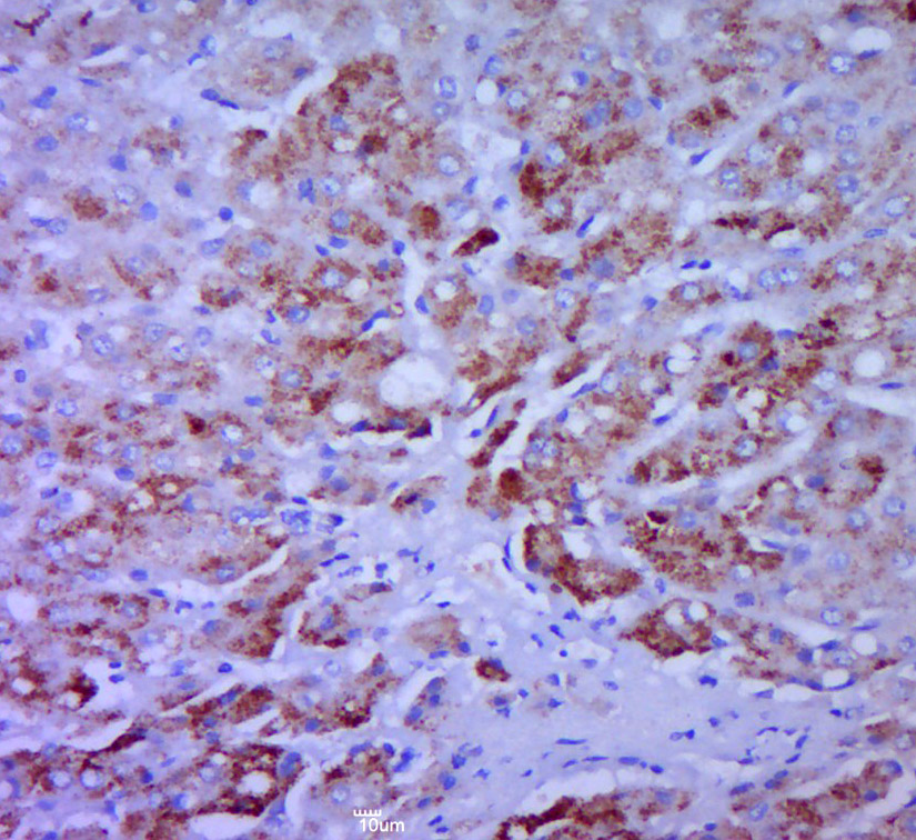 Paraformaldehyde-fixed, paraffin embedded human liver carcinoma; Antigen retrieval by boiling in sodium citrate buffer (pH6.0) for 15min; Block endogenous peroxidase by 3% hydrogen peroxide for 20 minutes; Blocking buffer (normal goat serum) at 37°C for 30min; Antibody incubation with CCL20 Polyclonal Antibody, Unconjugated (bs-1268R) at 1:400 overnight at 4°C, followed by a conjugated secondary for 20 minutes and DAB staining.