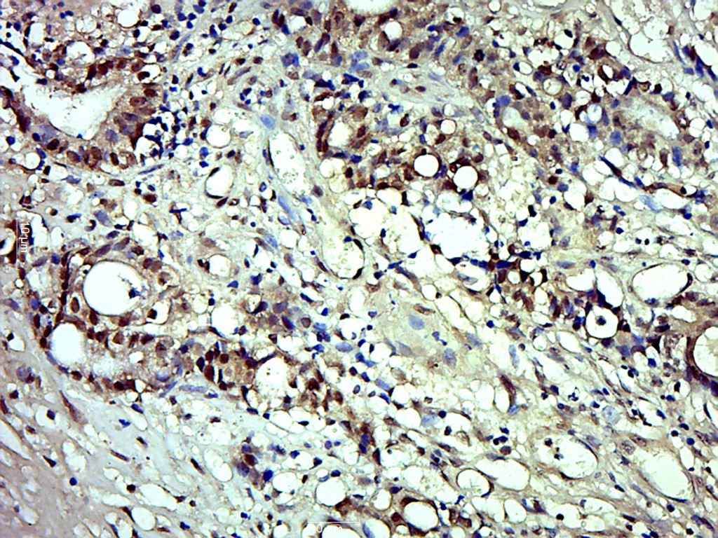 Paraformaldehyde-fixed, paraffin embedded human colon carcinoma; Antigen retrieval by boiling in sodium citrate buffer (pH6.0) for 15min; Block endogenous peroxidase by 3% hydrogen peroxide for 20 minutes; Blocking buffer (normal goat serum) at 37°C for 30min; Antibody incubation with phospho-MDM2 (Ser166) Polyclonal Antibody, Unconjugated (bs-3266R) at 1:500 overnight at 4°C, followed by a conjugated secondary for 20 minutes and DAB staining.