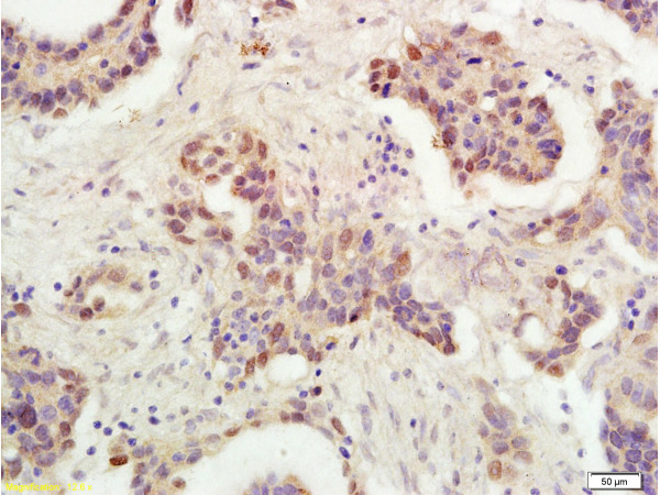 Formalin-fixed and paraffin embedded human ovarian carcinoma labeled with Rabbit Anti-P53 protein(wt-p53) Polyclonal Antibody (bs-0033R), Unconjugated 1:300 followed by conjugation to the secondary antibody and DAB staining