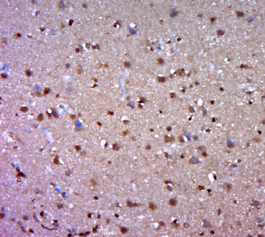 Paraformaldehyde-fixed, paraffin embedded human brain glioma; Antigen retrieval by boiling in sodium citrate buffer (pH6.0) for 15min; Block endogenous peroxidase by 3% hydrogen peroxide for 20 minutes; Blocking buffer (normal goat serum) at 37°C for 30min; Antibody incubation with C3orf25 Polyclonal Antibody, Unconjugated (bs-15170R) at 1:400 overnight at 4°C, followed by a conjugated secondary for 20 minutes and DAB staining.