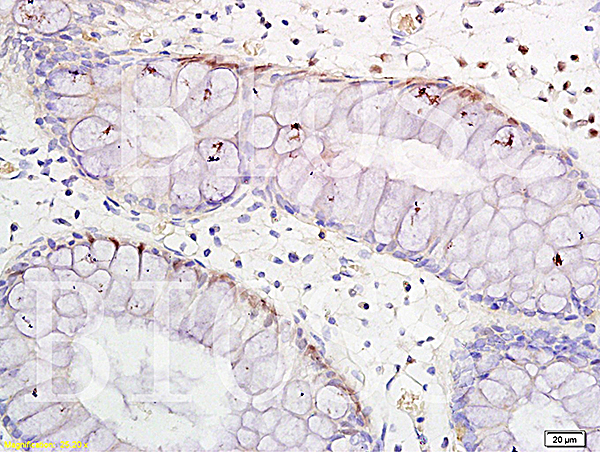 Formalin-fixed and paraffin embedded human colitis tissue labeled with Anti-TNF-alpha Polyclonal Antibody, Unconjugated(bs-0077R) 1:300 followed by conjugation to the secondary antibody and DAB staining\\n