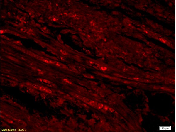 Formalin-fixed and paraffin embedded labeled with  human gastric carcinoma Rabbit Anti-AIF Polyclonal Antibody, Unconjugated (bs-0037R) 1:300 followed by conjugation to the secondary antibody Goat Anti-Rabbit IgG, PE