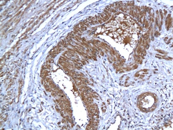 Formalin-fixed and paraffin embedded human cervical tissue labeled with Anti-AIF Polyclonal Antibody, Unconjugated (bs-0037R), followed by conjugation to the secondary antibody and DAB staining
