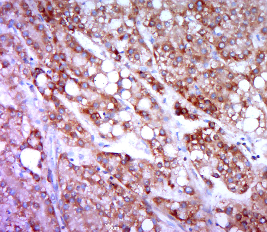 Paraformaldehyde-fixed, paraffin embedded human liver carcinoma; Antigen retrieval by boiling in sodium citrate buffer (pH6.0) for 15min; Block endogenous peroxidase by 3% hydrogen peroxide for 20 minutes; Blocking buffer (normal goat serum) at 37°C for 30min; Antibody incubation with HRH4 Polyclonal Antibody, Unconjugated (bs-10165R) at 1:400 overnight at 4°C, followed by a conjugated secondary for 20 minutes and DAB staining.