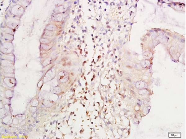 Formalin-fixed and paraffin embedded human colitis tissue labeled with Anti-TNF-alpha Polyclonal Antibody, Unconjugated(bs-0077R) 1:300 followed by conjugation to the secondary antibody and DAB staining\\n