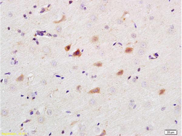 Formalin-fixed and paraffin embedded human colon carcinoma labeled with Anti-Caspase-9 Polyclonal Antibody, Unconjugated(bs-0049R) 1:200 followed by conjugation to the secondary antibody and DAB staining