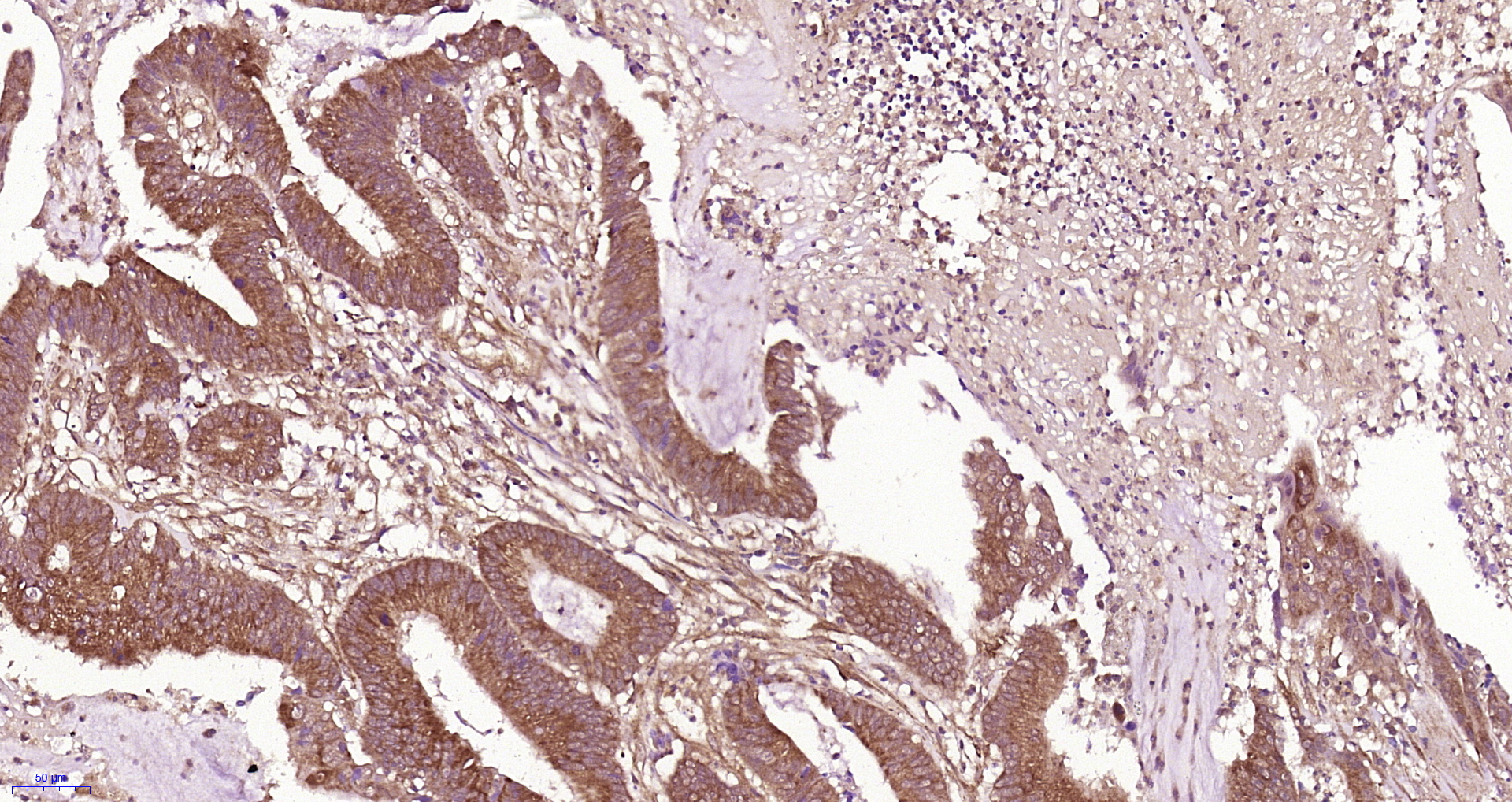 Paraformaldehyde-fixed, paraffin embedded Human colon cancer; Antigen retrieval by boiling in sodium citrate buffer (pH6.0) for 15min; Block endogenous peroxidase by 3% hydrogen peroxide for 20 minutes; Blocking buffer (normal goat serum) at 37°C for 30min; Antibody incubation with CLEC9A Polyclonal Antibody, Unconjugated (bs-13620R) at 1:400 overnight at 4°C, followed by a conjugated secondary antibody for 20 minutes and DAB staining.