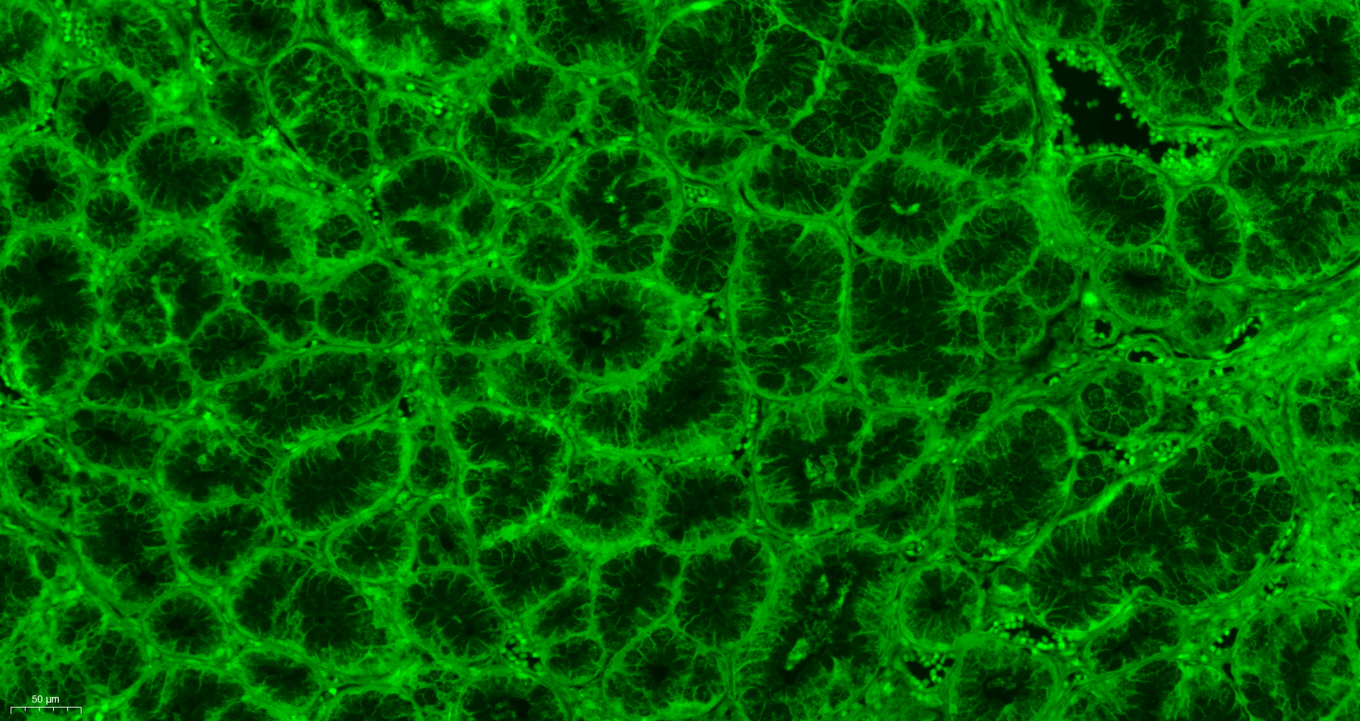Paraformaldehyde-fixed, paraffin embedded human stomach cancer; Antigen retrieval by boiling in sodium citrate buffer (pH6.0) for 15min; Block endogenous peroxidase by 3% hydrogen peroxide for 20 minutes; Blocking buffer (normal goat serum) at 37°C for 30min; Incubation: Anti-Caspase-9 Antibody, conjugated (bs-0049R-FITC) 1:400, 1.5 hours at 37°C