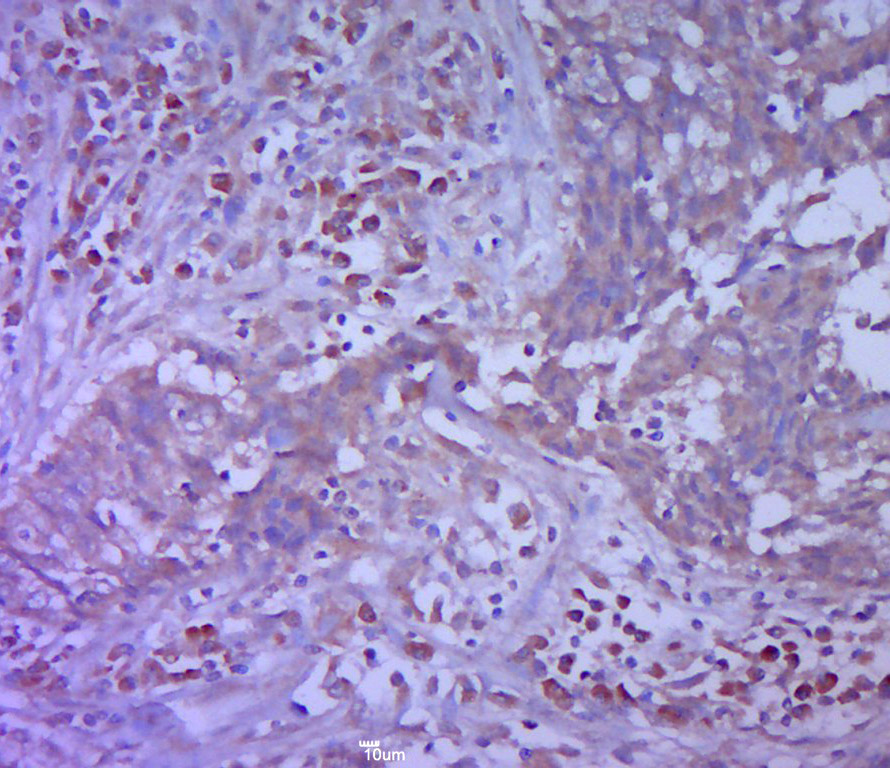 Paraformaldehyde-fixed, paraffin embedded human cervical cancer section; Antigen retrieval by boiling in sodium citrate buffer (pH6.0) for 15min; Block endogenous peroxidase by 3% hydrogen peroxide for 20 minutes; Blocking buffer (normal goat serum) at 37°C for 30min; Antibody incubation with Vimentin Polyclonal Antibody, Unconjugated (bs-23063R) at 1:400 overnight at 4°C, followed by a conjugated secondary antibody for 20 minutes and DAB staining.