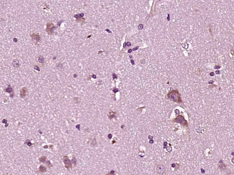 Paraformaldehyde-fixed, paraffin embedded human brain glioma; Antigen retrieval by boiling in sodium citrate buffer (pH6) for 15min; Block endogenous peroxidase by 3% hydrogen peroxide for 30 minutes; Blocking buffer (normal goat serum) at 37°C for 20min; Antibody incubation with YKL39/CHI3L2 Polyclonal Antibody, Unconjugated (bs-1238R) at 1:200 overnight at 4°C, followed by a conjugated secondary and DAB staining.